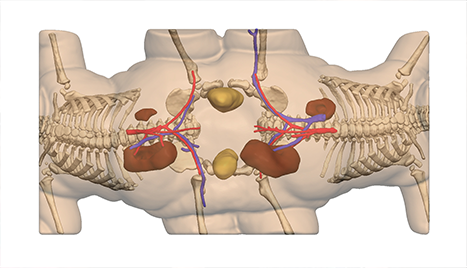 3D Systems Delivering a new life to Hernandez-Torres conjoined twins with VSP and 3D printed models